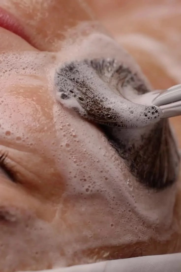 Карбоновый пилинг — результат процедуры