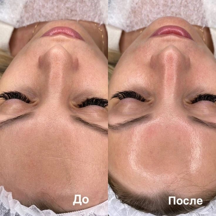 Карбоновый пилинг — результат процедуры