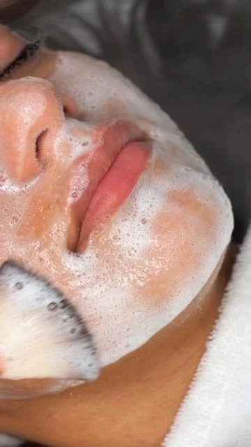 Карбоновый пилинг — результат процедуры