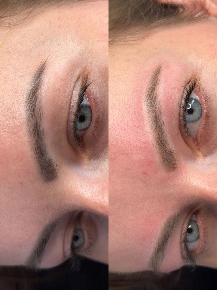 Удаление татуажа — до и после