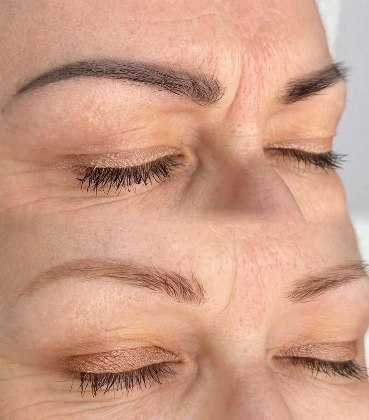 Удаление татуажа — до и после