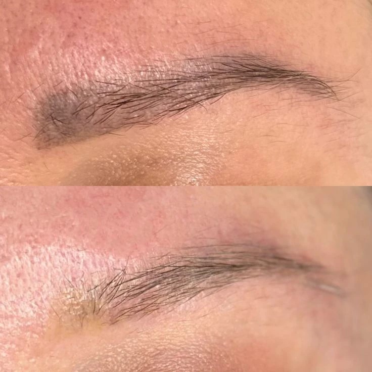 Удаление татуажа — до и после