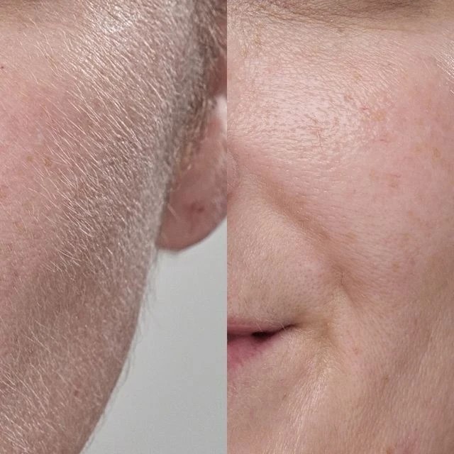 Результат женской депиляции